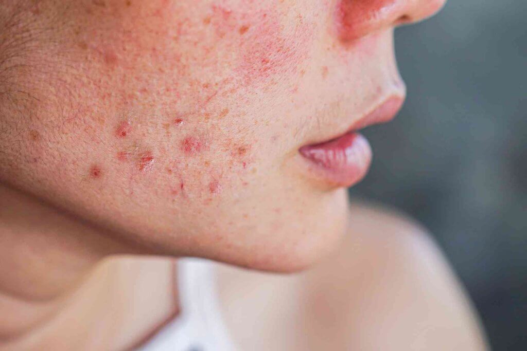 Adult acne
