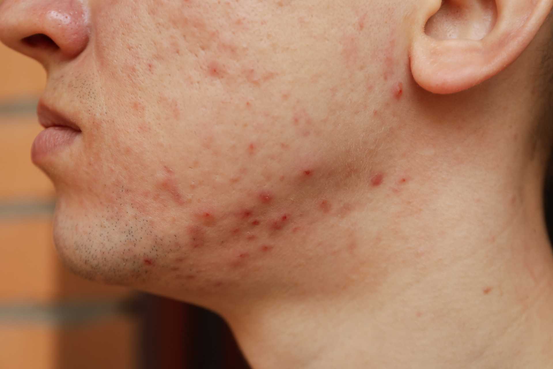 Acne Man Face & Neck