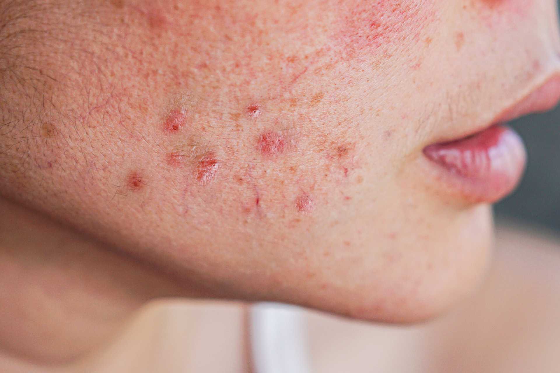 Acne Woman Face Face Red