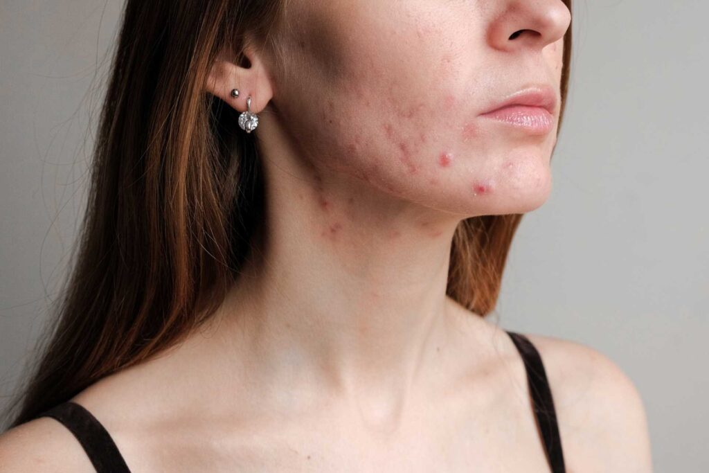 Acne Woman Face and Neck