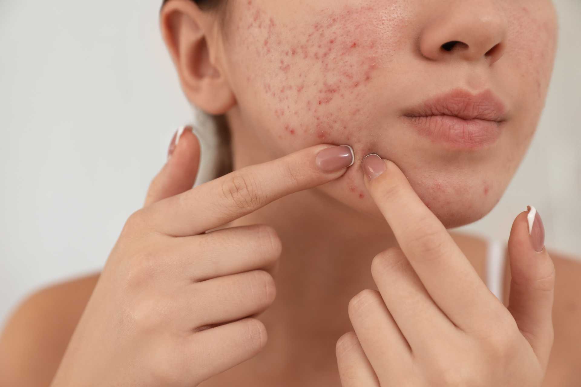 Acne Woman Squeezing Spot Face