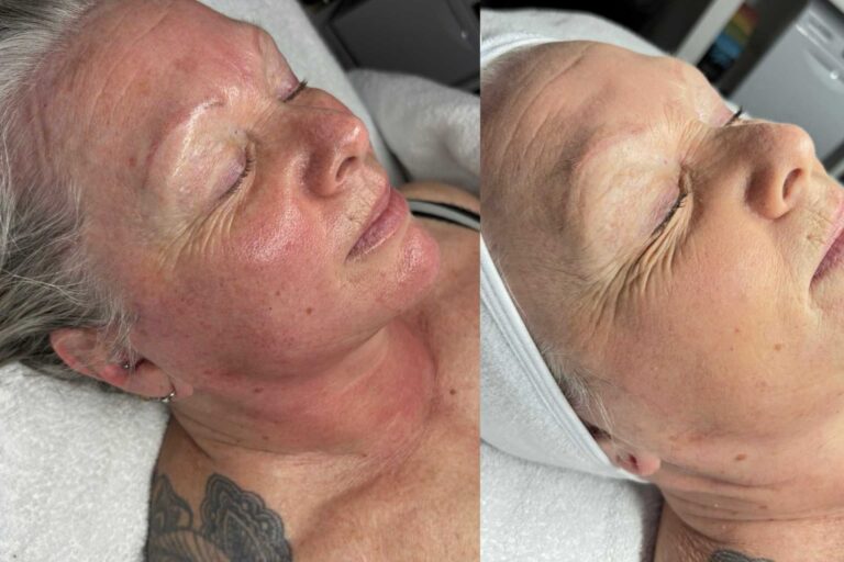 Collagen Lift Before After
