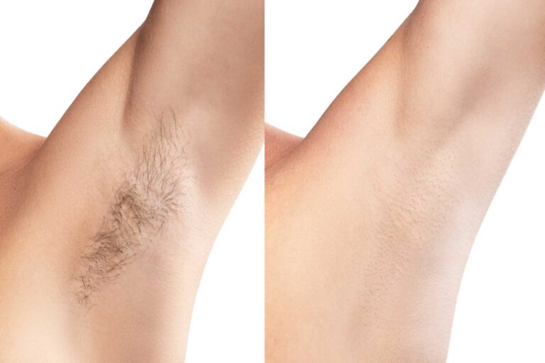 Laser Hair Reduction Underarm Before After