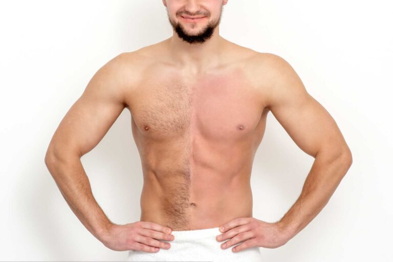 Laser Hair Removal Men Chest Before After
