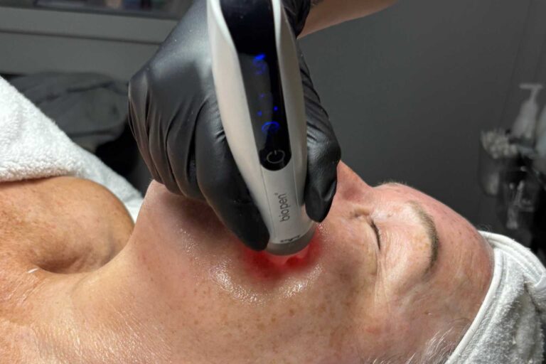 Skin Needling On Cheek